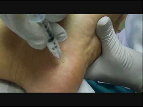 ultrasound guided injection for plantar fasciitis